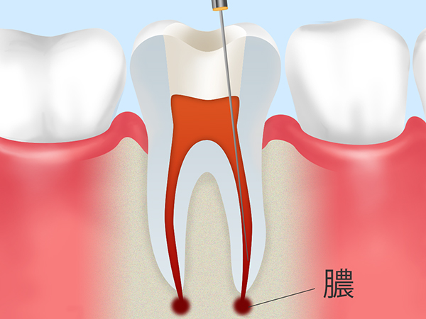 重度の虫歯でも歯を残す治療（根管治療）