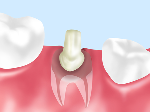 当歯医者では金属コアをほとんど使用していません